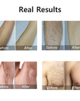 HOMEFISH Laser Epilator IPL Hair Removal