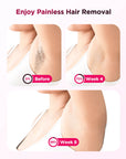 IPL Laser Hair Removal Device Ice-Cooling 3 in 1