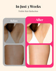 990000 Flashes Laser Hair Removal for Women
